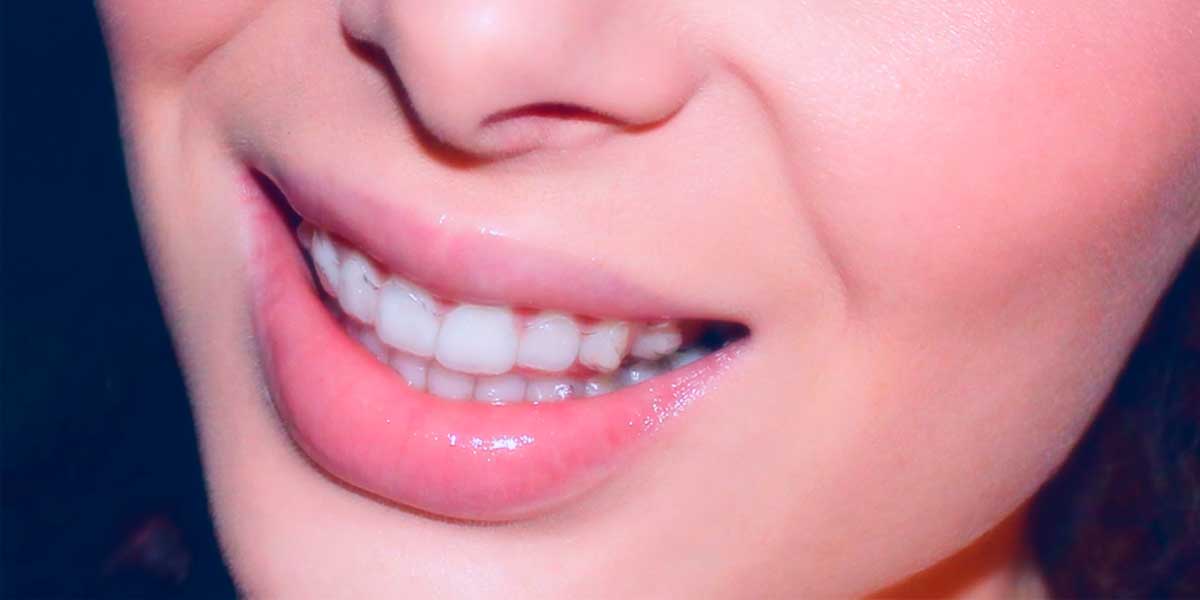 Ortodoncia Cómoda Y Estética
